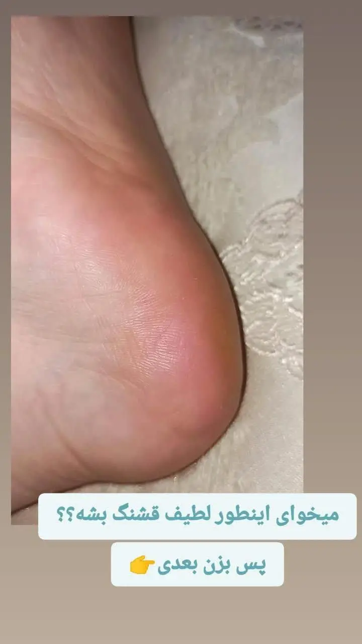 جوراب مخصوص ترک پاشنه پا
