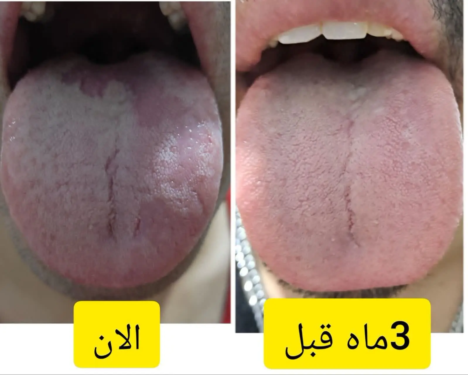 یه نمونه عکس زبان که در عرض ۳ماه اینقدر مشکل کبد جدیتر شده😔😔
