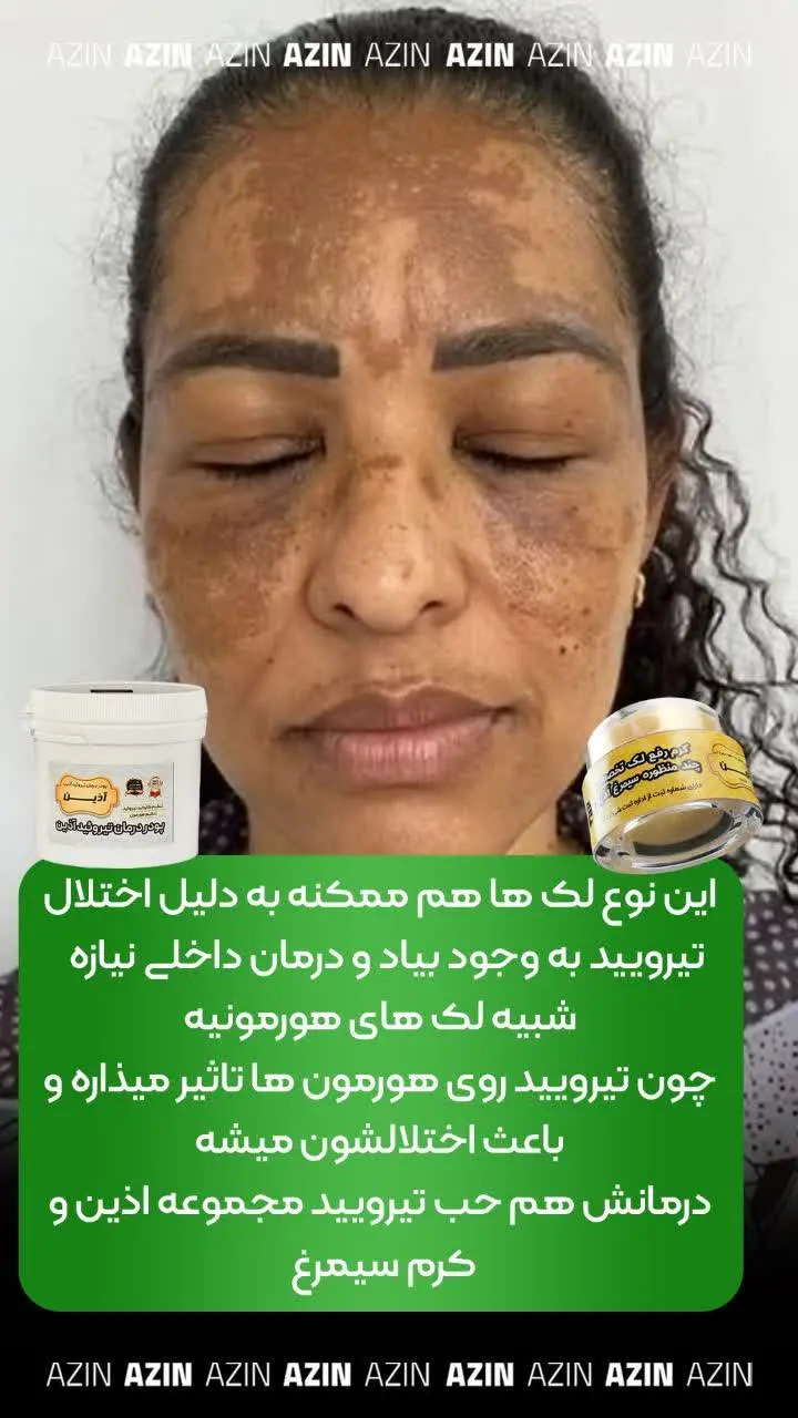 درمانش هم حب تیرویید مجموعه...