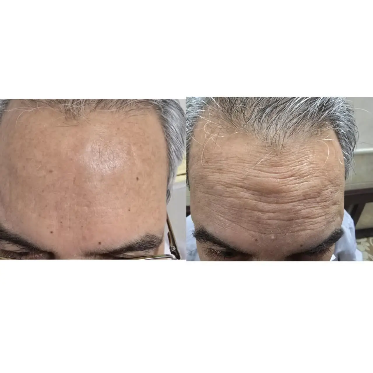 قبل و بعد فوق العاده از کرم...