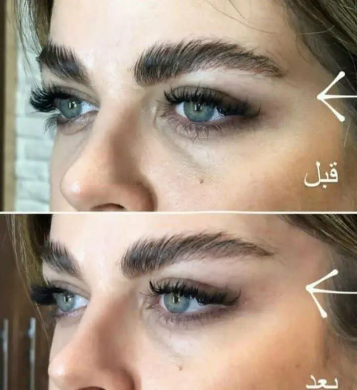 پرفروش ما کش لیفت
